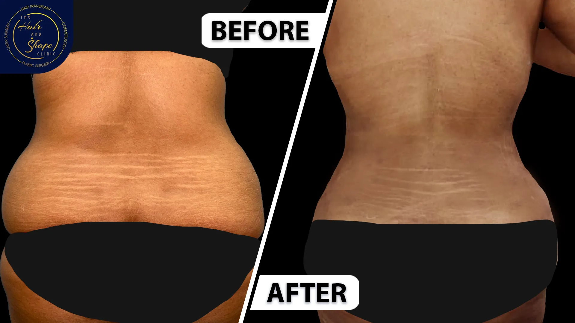 Back Liposuction result5